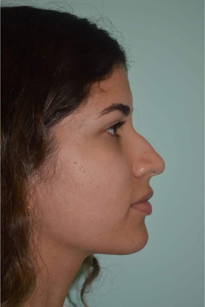 Before and After Pictures - Davis Facial Plastic Surgery