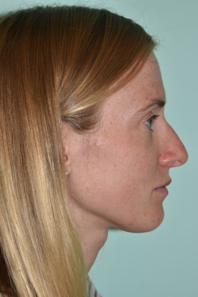 Before and After Pictures - Davis Facial Plastic Surgery