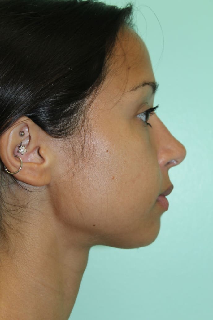 Before and After Pictures - Davis Facial Plastic Surgery