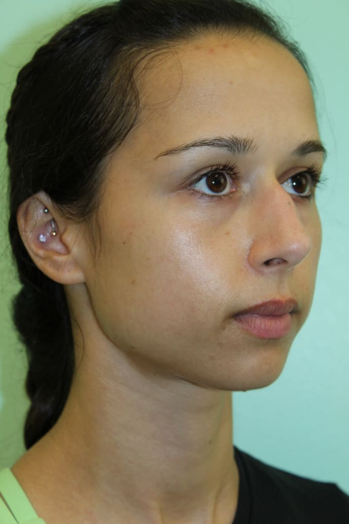 Before and After Pictures - Davis Facial Plastic Surgery