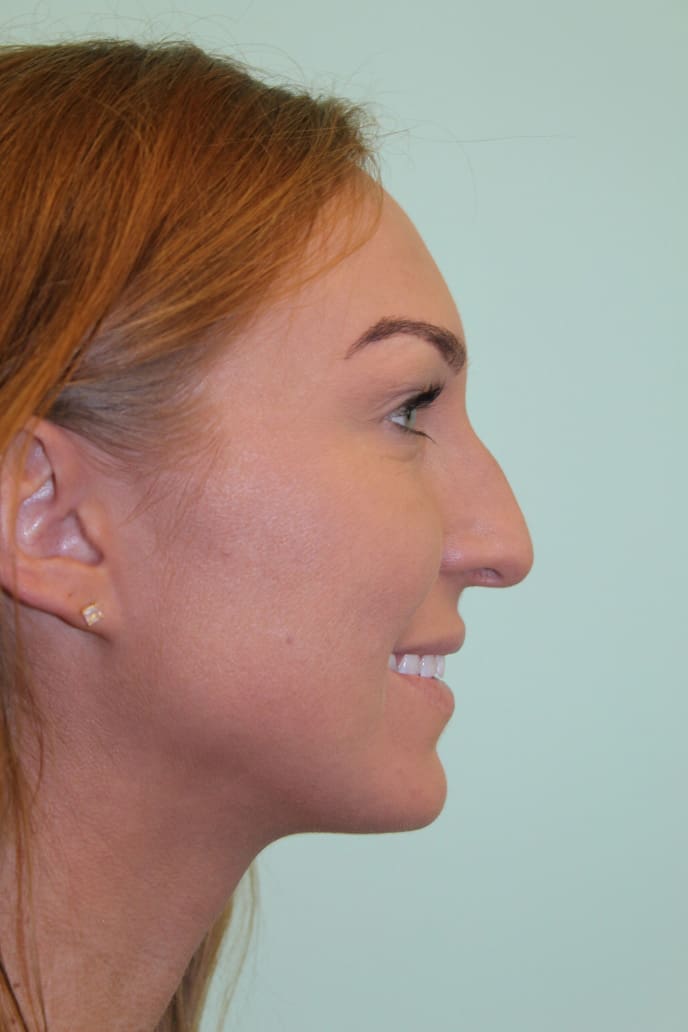 Before and After Pictures - Davis Facial Plastic Surgery